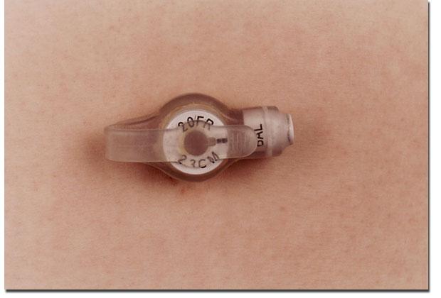 COMMON CAUSES OF LEAKAGE Is the gastrostomy button the correct size?