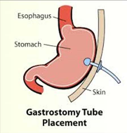 WHAT IS A GASTROSTOMY? Surgically made path (stoma) or opening into stomach from the abdominal wall.