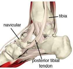 Tibialis posterior dysfunction Also known as Posterior tibial tendon dysfunction