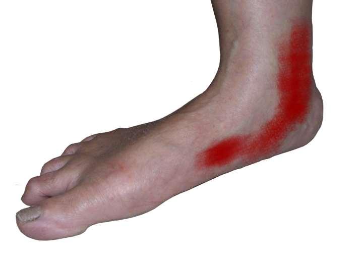 Symptoms and Signs Posteromedial ankle pain / swelling Progressive flattening of