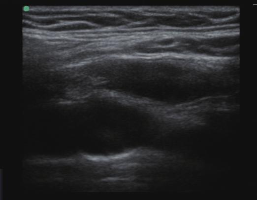 Dural sinus thrombosis identified by ultrasound use of emergency physician-performed point-of-care ultrasound allowed rapid identification of a thrombosis in the patient s internal jugular vein, with