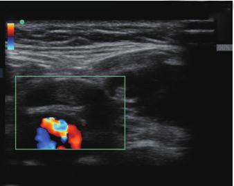 This case illustrates a novel use of point-of-care ultrasound to help detect DST.