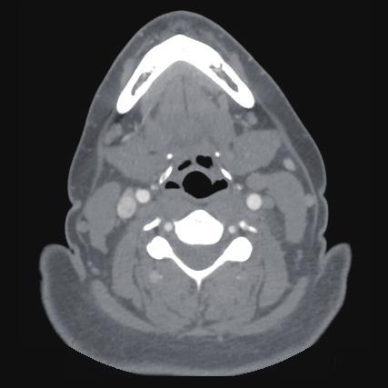 1). This lesion was noted to extend cranially as far as the treating physician could acquire an image in both long and short axis of the vessel.