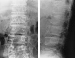This lateral lumbar spine radiographs showed primary postoperative state. Fig. 1-B.