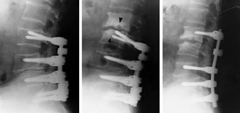 A B C Fig. 2-A. 58-year-old man underwent 3 times operation in lumbar spine with instrumentation. This radiograph showed last operative state. Fig. 2-B.