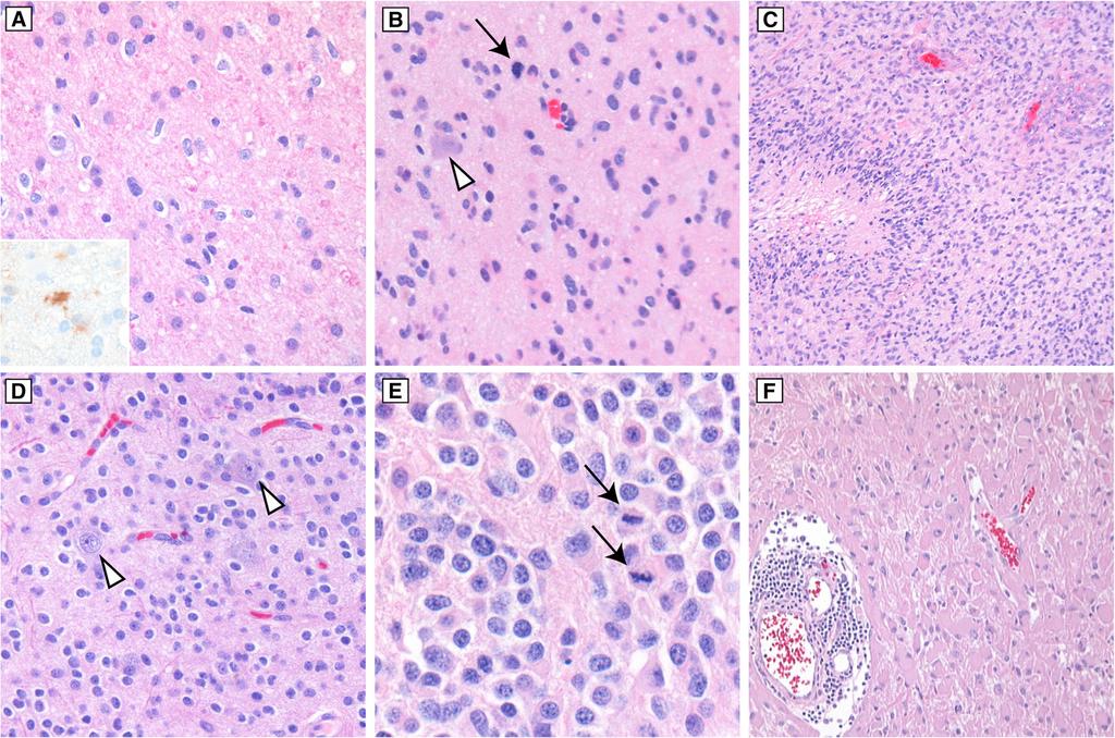 Wood et al. Diagnostic Pathology (2019) 14:29 Page 4 of 16 Fig. 2 Typical histologic features of infiltrating gliomas.