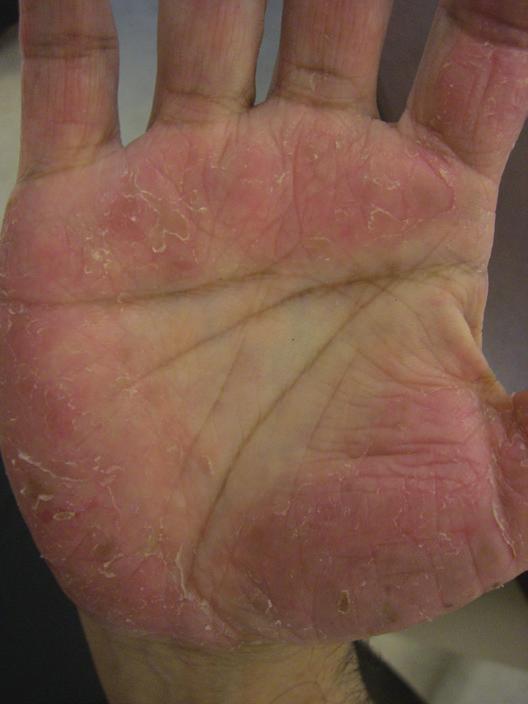 Eczema The main symptom of eczema is itching, which can be severe and persistent, especially at night. Scratching the affected area of skin usually causes a rash.