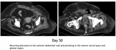The repeat CT scan on day 50 showed abscesses recurring in the anterior abdominal wall and persisting in the anterior sacral space and gluteal region (Fig. 4).