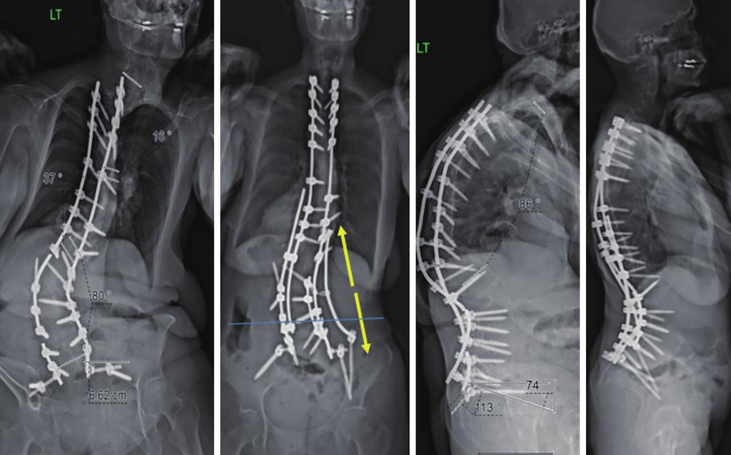 800 Makhni et al. Kickstand rod technique A B C D Figure 1 Pre- and postoperative imaging of a 62-year-old woman who presented with severe coronal and sagittal imbalance.