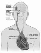 Intraventricular in ventricle 48 49 Basal Ganglia Cerebellum Thalamus Pons Common Stroke Areas White