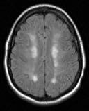 52 53 Watershed MRI Transient Ischemic Attack