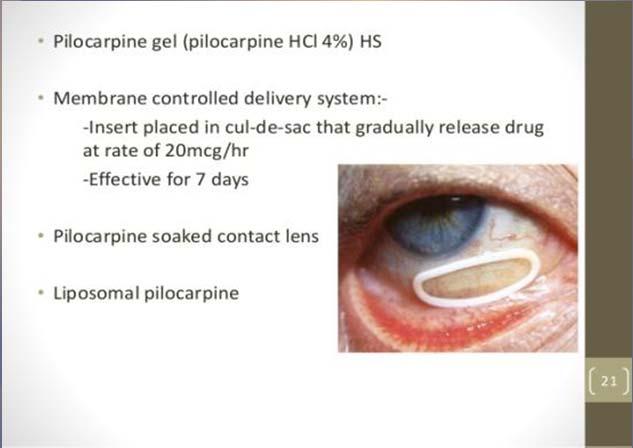 innovative drug form treats glaucoma sandwich drug (Pilocarpine) between very thin plastic membranes place under
