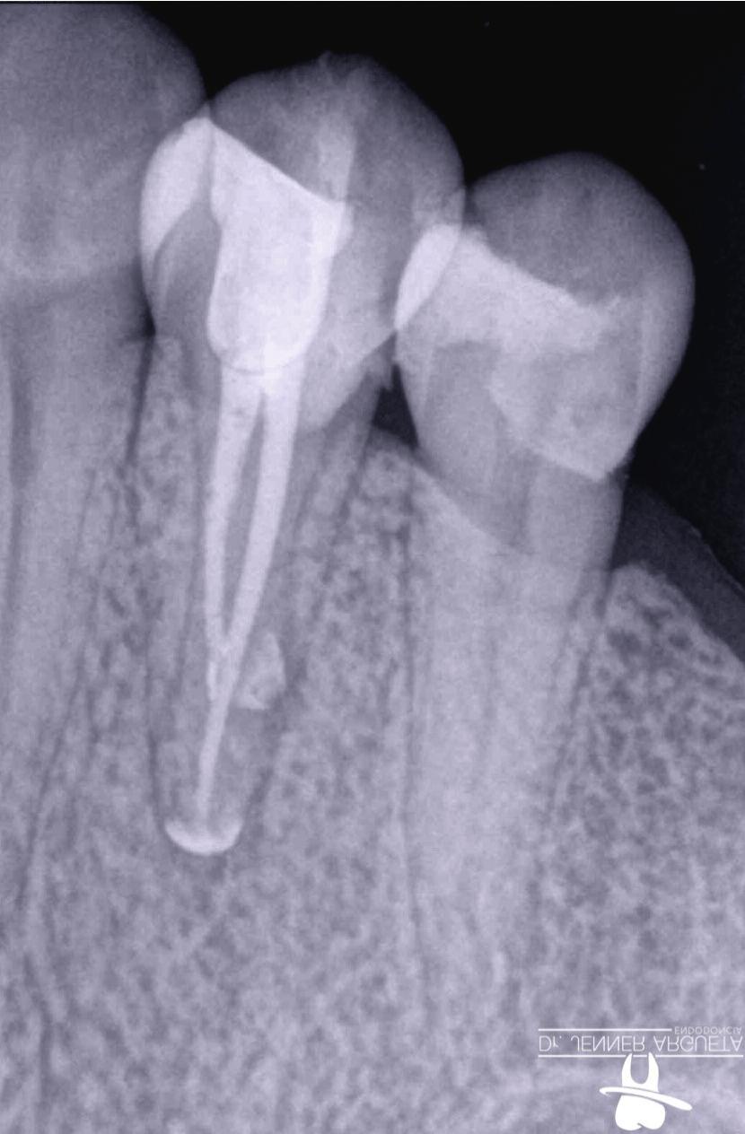 3: Photograph of the restoration in the cervical area prior to the root canal treatment.