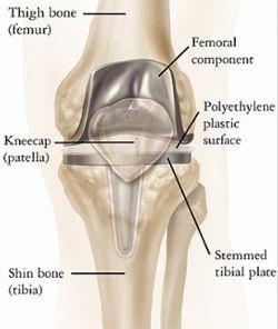 What it arthritis? Arthritis is simply the wearing away of the cartilage at the bone ends within the joint.