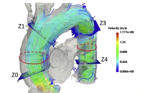 4D MRI and aortic stiffness
