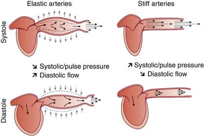 Arterial Stiffness Arterial stiffening results in increased pulse pressure, left ventricular hypertrophy,