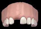 They represent the solution for cases of missing teeth or even for the reconstruction of
