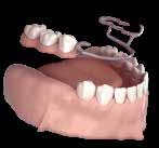 obtaining the same effect as a natural tooth, avoiding the need for inserting a bridge.