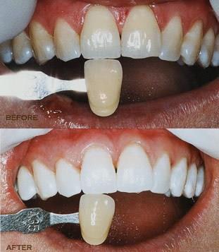 Tooth whitening -