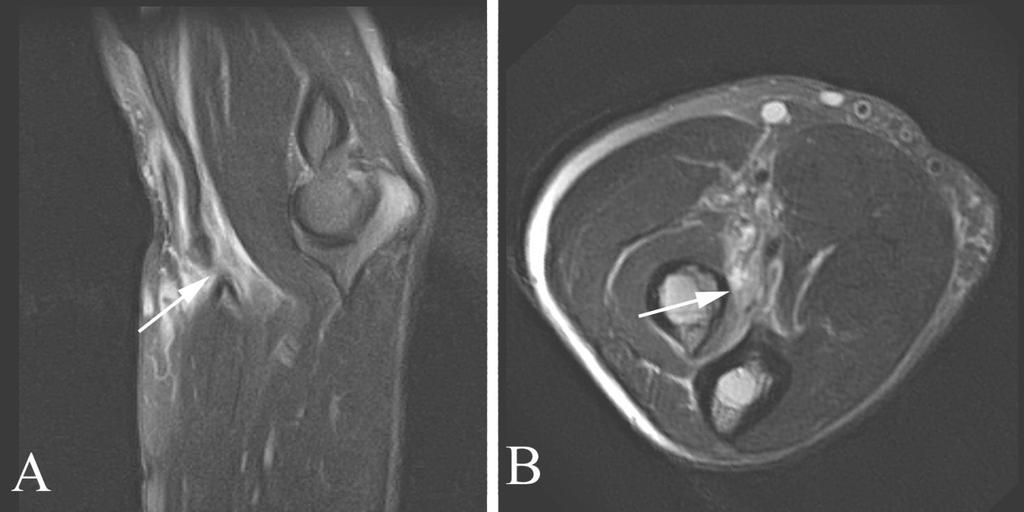 10/6/2012 Radiology Quiz of the Week #93 Page 4 IMAGING STUDY QUESTIONS AND ANSWER Imaging questions: 1) What type of study is shown? Sagittal (A) and axial (B) elbow magnetic resonance study.