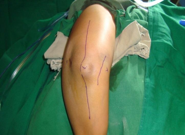Fig 6: Skin incision marking Fig 10: Fixation of