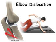 Introduction When the joint surfaces of an elbow are forced apart, the elbow is dislocated. The elbow is the second most commonly dislocated joint in adults (after shoulder dislocation).