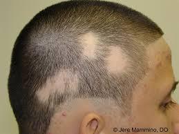 Alopecia Areata (AA) Background AA is an autoimmune condition, characterized by patchy, nonscarring hair loss on the scalp and body Large unmet need: >6.