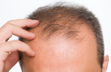 Additional Potential Indications Androgenic alopecia (male and female pattern hair loss) AGA is the most common cause of