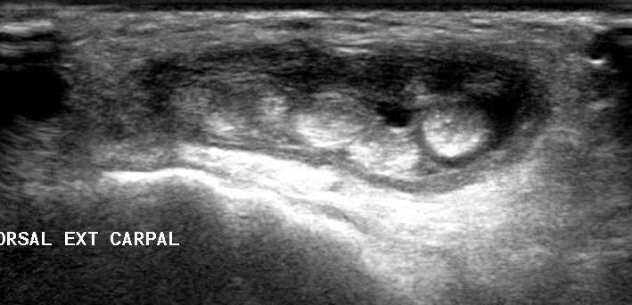 Abnormal hypoechoic intra-articular tissue