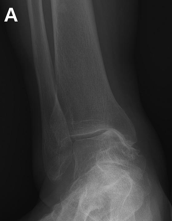 Fig. E-3A Preoperative weight-bearing anteroposterior radiograph showing medial ankle osteoarthritis with mortise widening