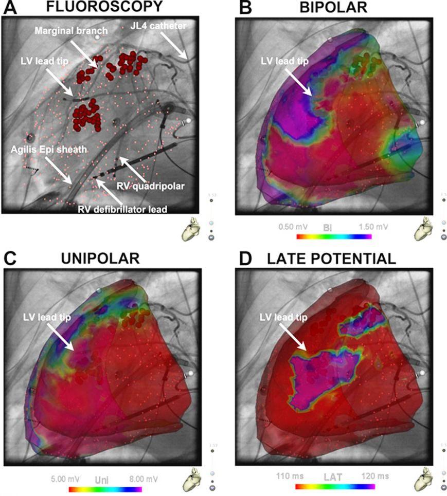 Left ventricular (LV) lead/scar relationship during endoepicardial ablation: A) Fluoroscopy showing LV lead tip, epicardial access sheath, overlaid epicardial ablation points, and their relation with