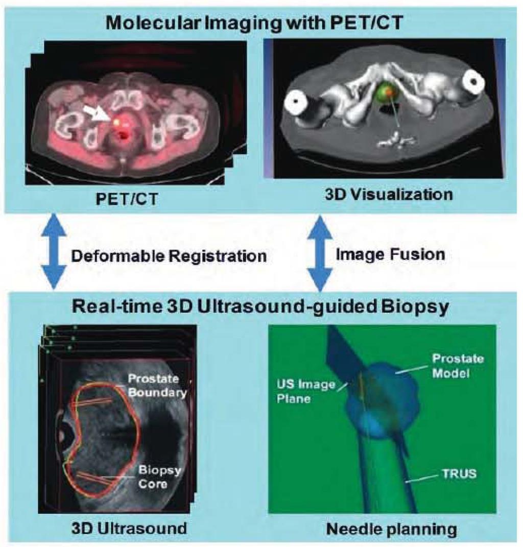 Fei et al. Page 6 FIGURE 1. Molecular image-directed, 3D ultrasound-guided biopsy. Top: PET/CT image using 18F- FACBC are acquired from a prostate patient.