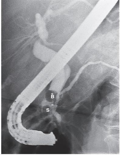 case no 4 Endoscopic removal of stones in the common bile duct (CBD).