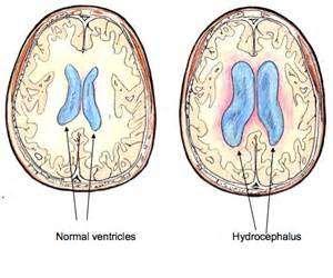 hydrocephalus:
