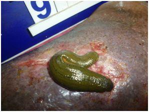 In case of some ulcerated and wounded patient debridement is carried out. Before starting of the leech therapy patients were well explained about leech and its use in treatment.
