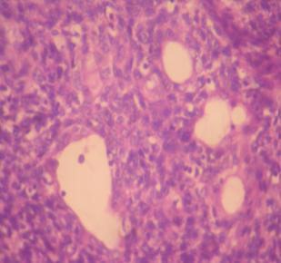 tumor cells. Fig. 7: H & E stained 10 x Fig.