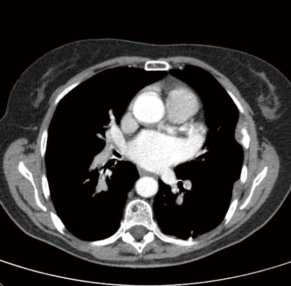 Daniels AM et al. A rare disease course mcg/l. Imaging diagnosis Computed tomography (CT) shows a lesion of 1.5 centimeters located in the inferior lobe of the left lung.