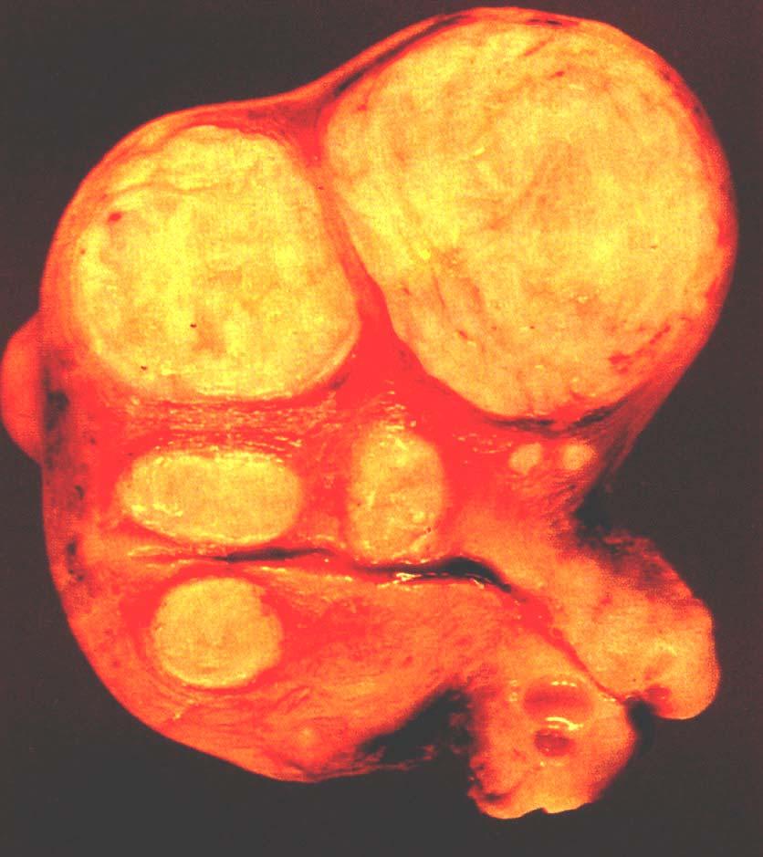 leiomyoma multiple