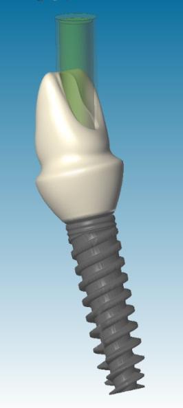 12. Angulated abutment screw It is now possible to design angled screw hole through custom abutments that will complement the angle permissive implants.