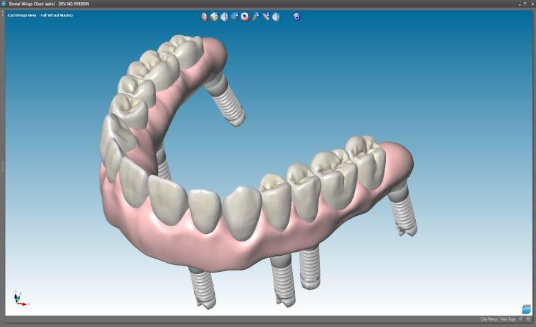 2. Virtual wax-up Figure 19: Full virtual wax-up Figure 18: Full virtual wax-up with reduced anatomies With this new feature, you can generate a virtual wax-up over a scanned model or an imported