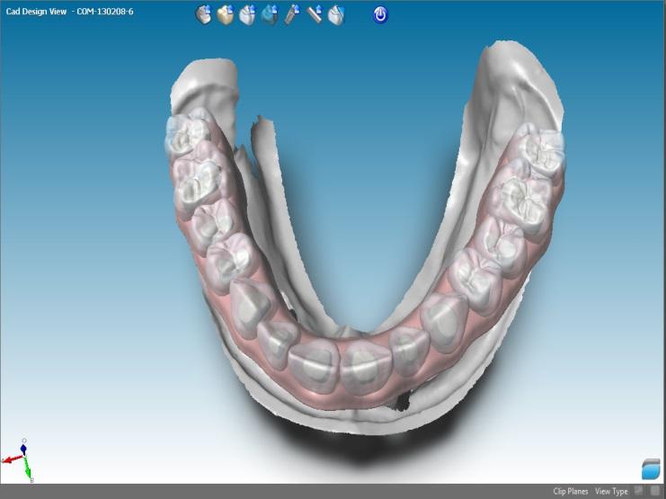 Gingiva: Set virtual gingiva parameters, as width and thickness. 11. Under the Prosthesis menu: Figure 24: Recompute virtual waxing, with 2 tabs.