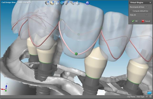 14. Under the virtual gingiva menu Edit gingiva line: Click on a tooth to activate the 4 green handles. Position them around to determine the gingiva line.