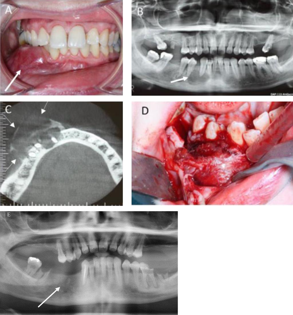 Fig. 1. (A) Intraoral view showing a lower right vestibular swelling. (B) Orthopantogram showing the lesion at the apex of tooth 43.