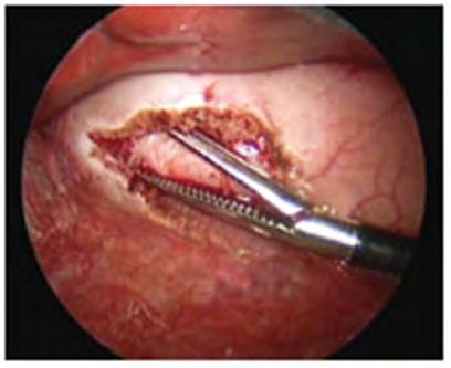 Pyloric Stenosis Caution with this surgery Do not disrupt the mucosa What happens if you do?