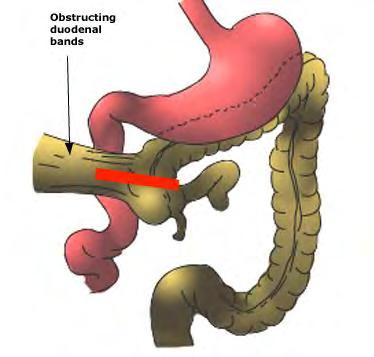 the gut Normal v abnormal rotation