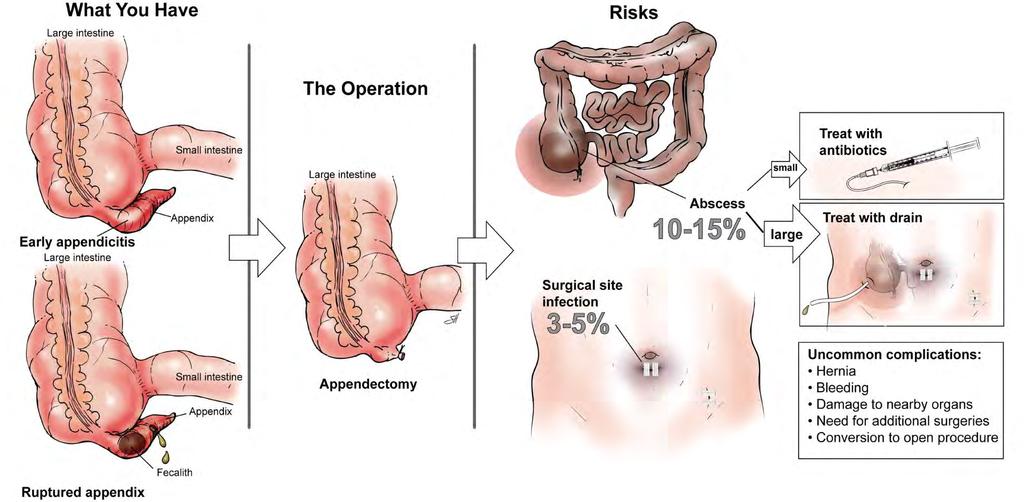 Appendicitis Will vary depending on age of the