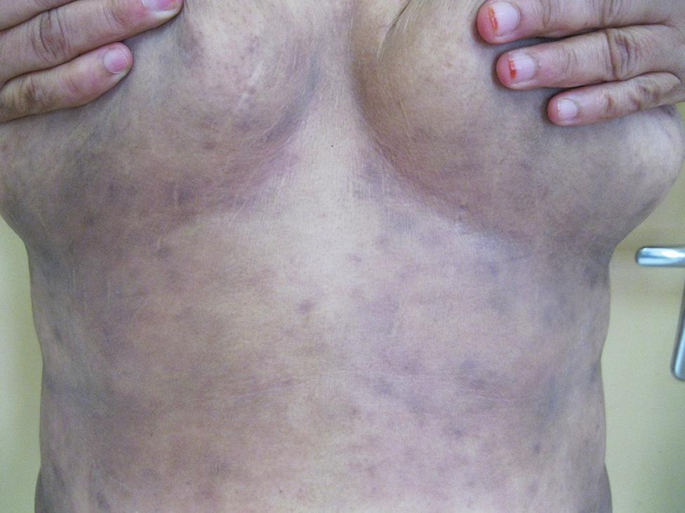 were constant findings in all cases (Fig. 3). Hyperkeratosis was marked in 11 (36.6%). Prevalence of AD was higher in LPP patients (40.0%) than in the control group (3.3%).