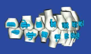 Simulations of treatment results empower you to evaluate tooth movement of your digital design.