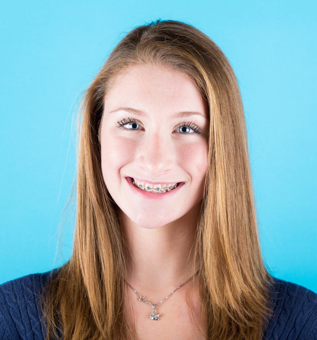 Throughout the orthodontic industry, it is common to find out about retainer fees after you start treatment.