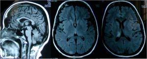 Figure -2: T2W MRI showing hyperintense lesions in cervical cord, left medulla and left cerebellum.
